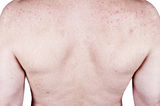 Adult Male Acne Skins Problems Blemishes, Rash Stock Photography